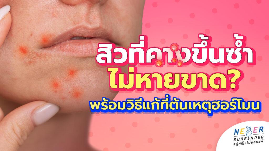 สิวที่คางขึ้นซ้ำไม่หายขาด? เจาะสาเหตุทำไมทายาอย่างเดียวไม่พอ พร้อมวิธีแก้ที่ต้นเหตุฮอร์โมน 